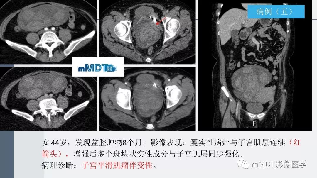 【PPT】子宫平滑肌瘤(子宫肌瘤)影像诊断