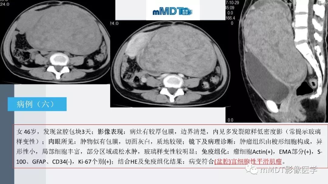 【PPT】子宫平滑肌瘤(子宫肌瘤)影像诊断