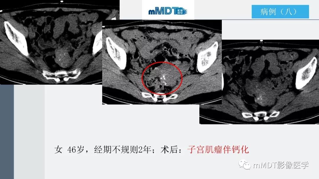 【PPT】子宫平滑肌瘤(子宫肌瘤)影像诊断