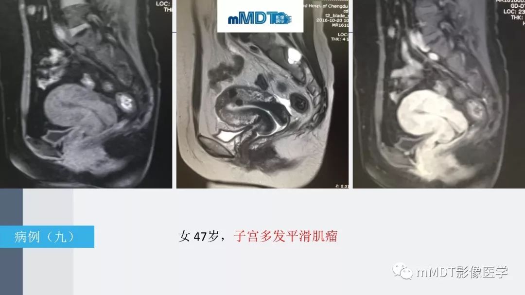 【PPT】子宫平滑肌瘤(子宫肌瘤)影像诊断