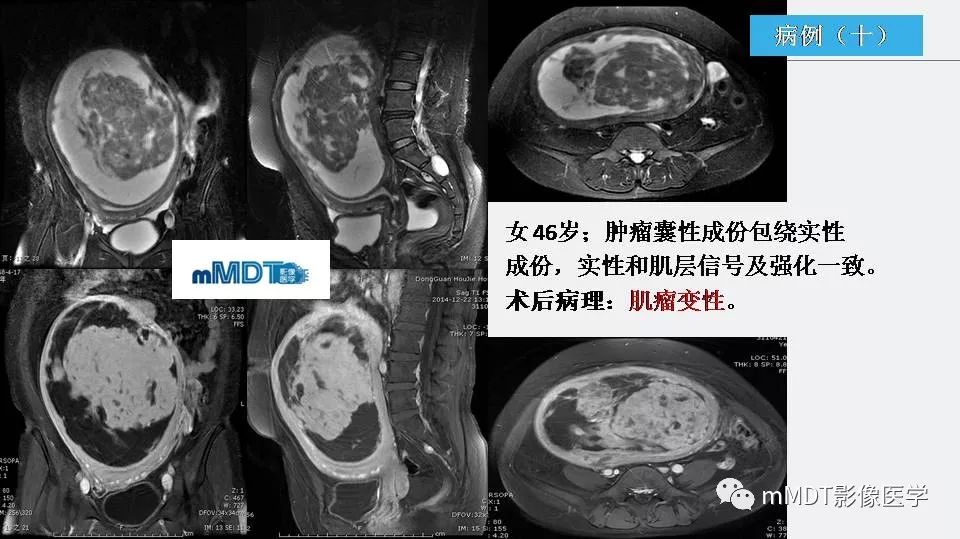 【PPT】子宫平滑肌瘤(子宫肌瘤)影像诊断
