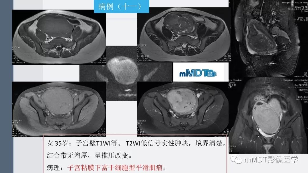 【PPT】子宫平滑肌瘤(子宫肌瘤)影像诊断