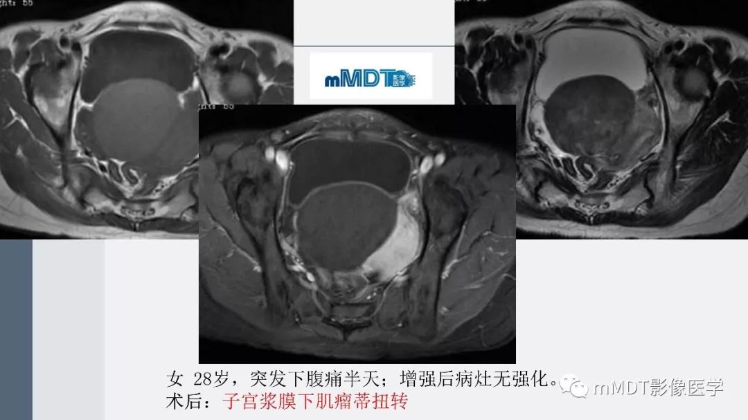 【PPT】子宫平滑肌瘤(子宫肌瘤)影像诊断