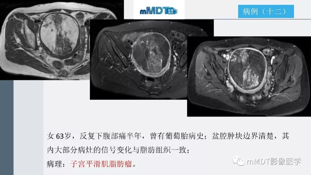 【PPT】子宫平滑肌瘤(子宫肌瘤)影像诊断