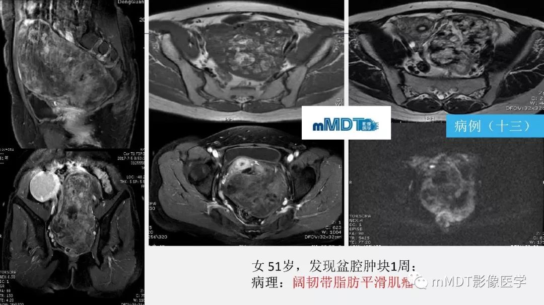 【PPT】子宫平滑肌瘤(子宫肌瘤)影像诊断