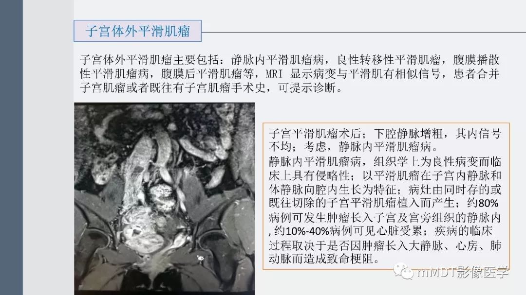 【PPT】子宫平滑肌瘤(子宫肌瘤)影像诊断