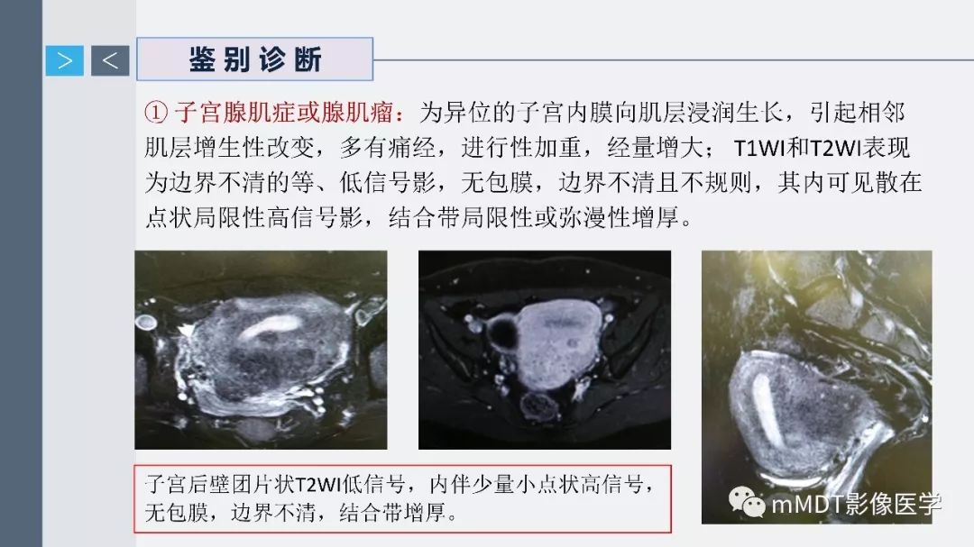 【PPT】子宫平滑肌瘤(子宫肌瘤)影像诊断