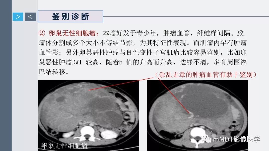 【PPT】子宫平滑肌瘤(子宫肌瘤)影像诊断