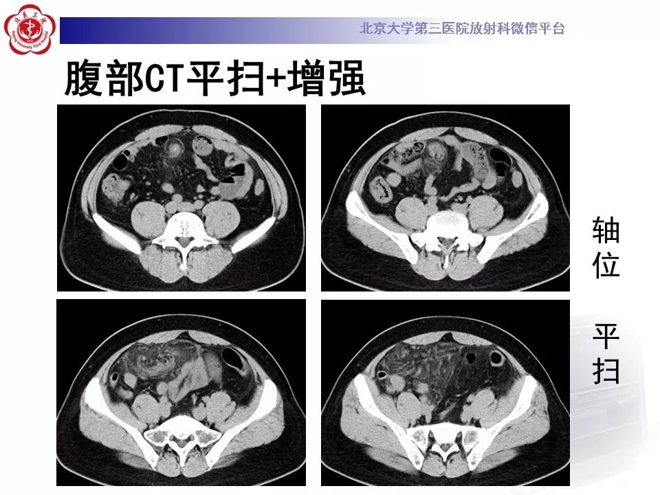 【病例】大网膜扭转1例CT影像诊断