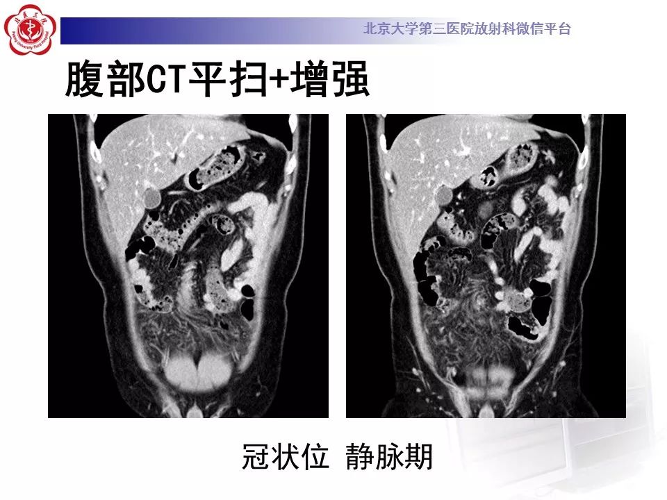 【病例】大网膜扭转1例CT影像诊断