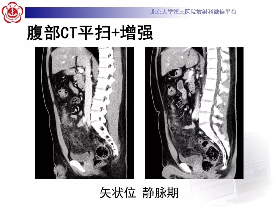 【病例】大网膜扭转1例CT影像诊断