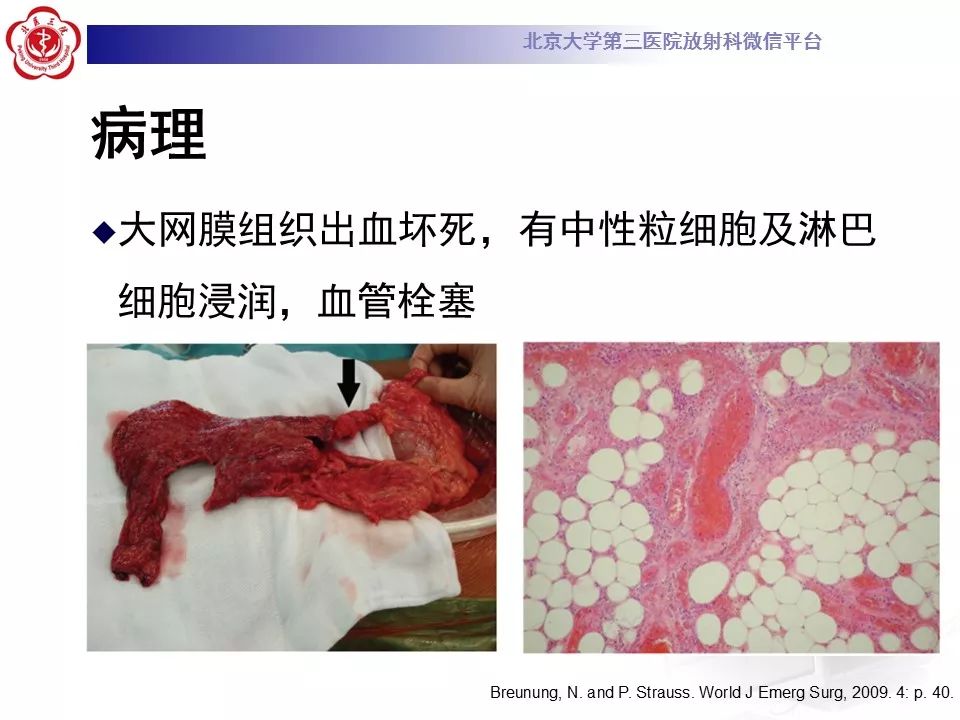 【病例】大网膜扭转1例CT影像诊断
