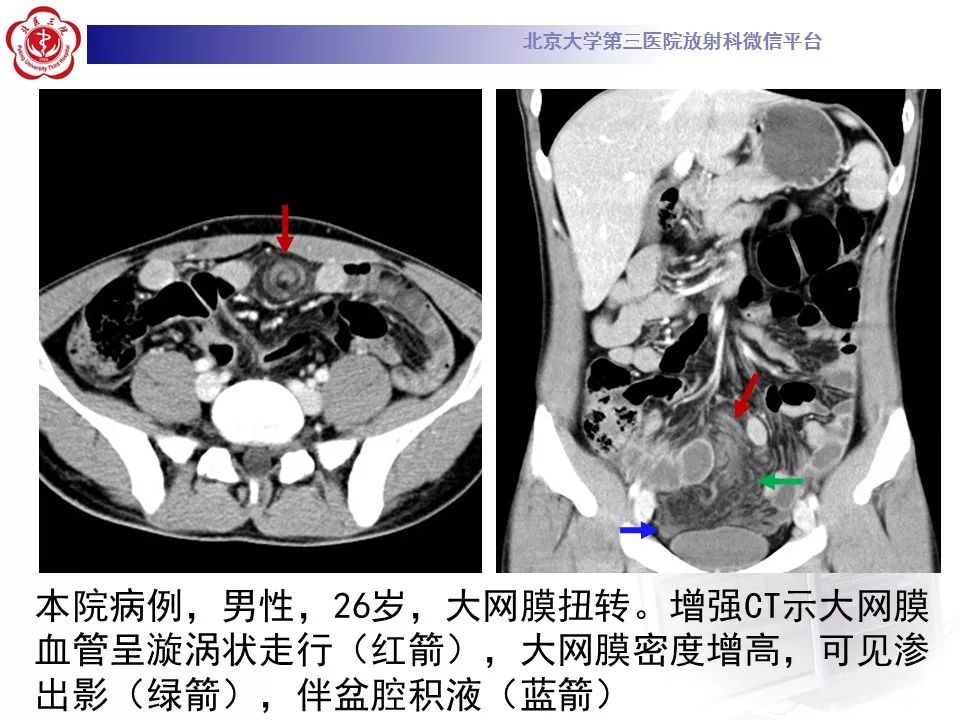 【病例】大网膜扭转1例CT影像诊断