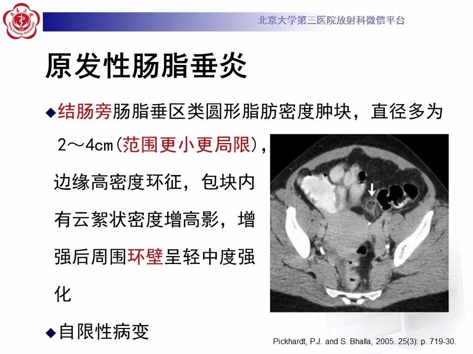 【病例】大网膜扭转1例CT影像诊断