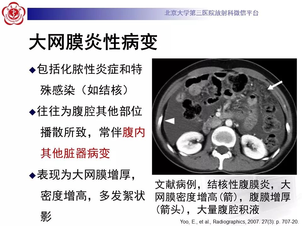 【病例】大网膜扭转1例CT影像诊断