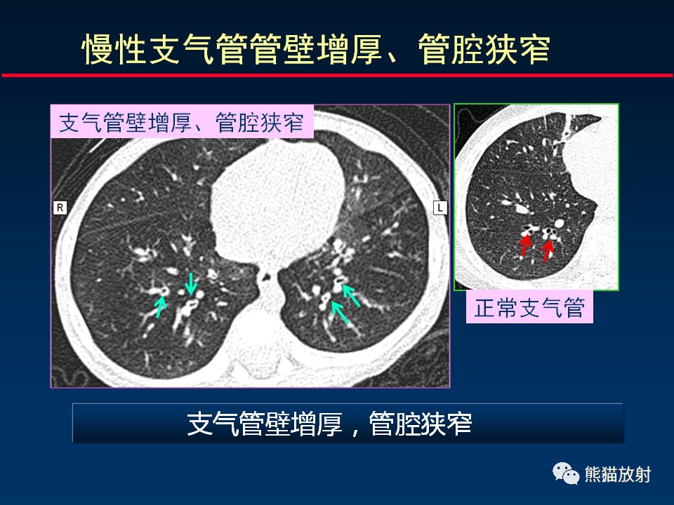 【PPT】放射科医生如何应对慢阻肺