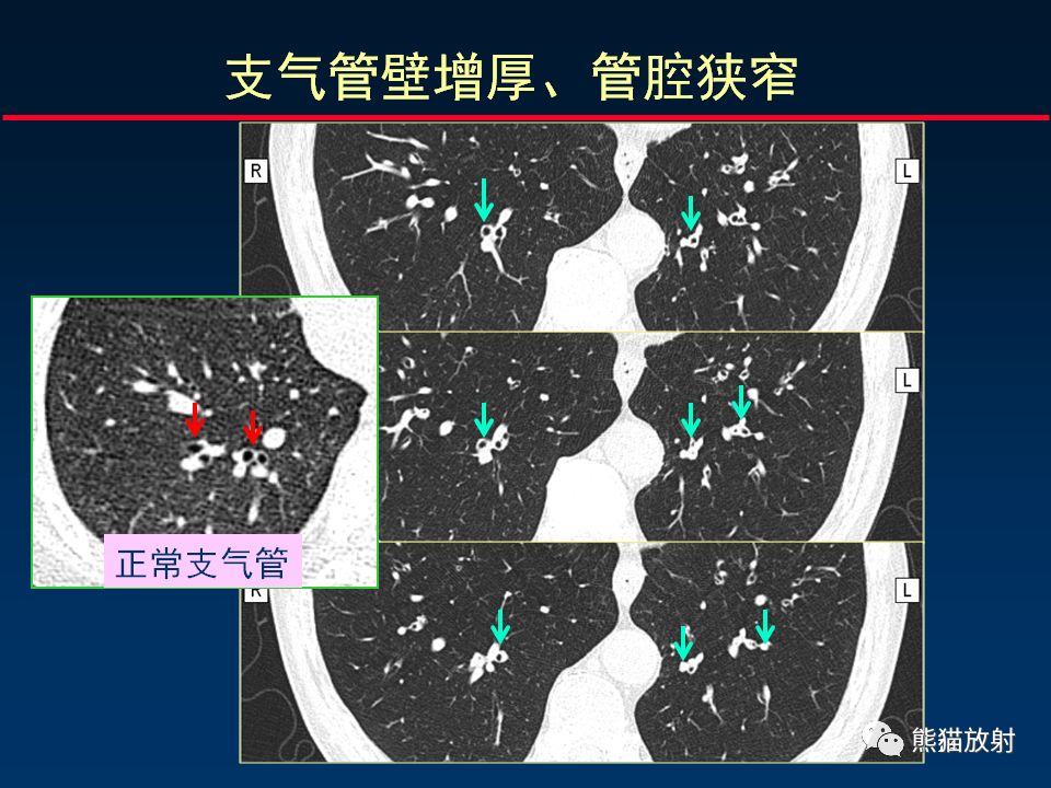 【PPT】放射科医生如何应对慢阻肺