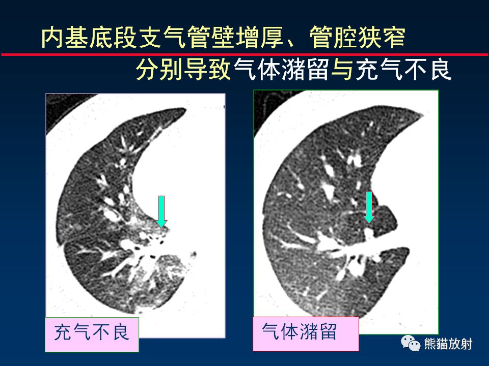 【PPT】放射科医生如何应对慢阻肺