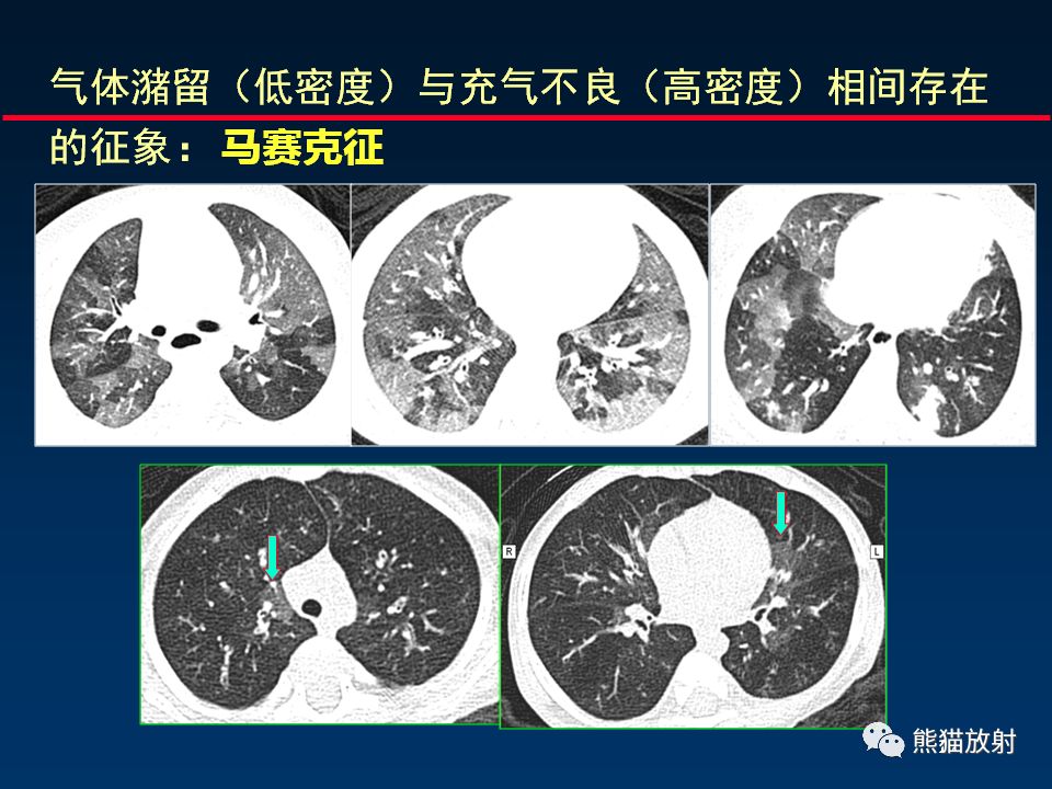 【PPT】放射科医生如何应对慢阻肺