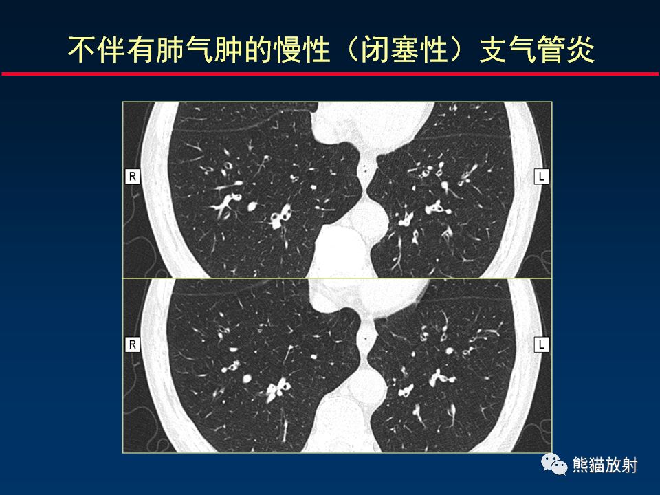 【PPT】放射科医生如何应对慢阻肺