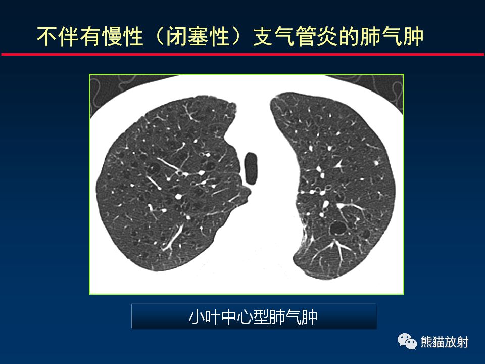 【PPT】放射科医生如何应对慢阻肺