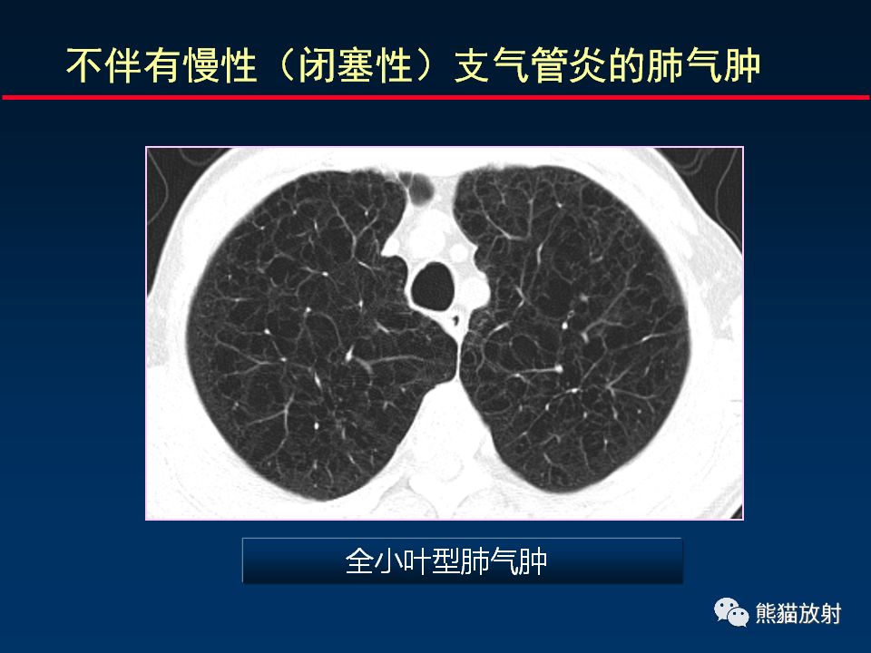 【PPT】放射科医生如何应对慢阻肺