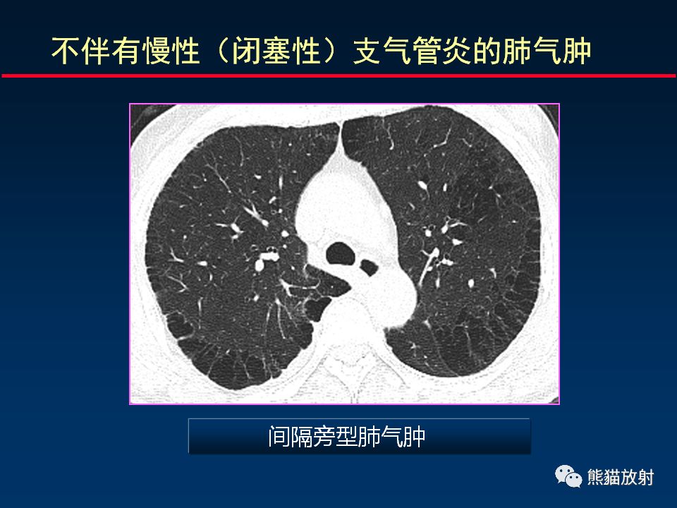 【PPT】放射科医生如何应对慢阻肺