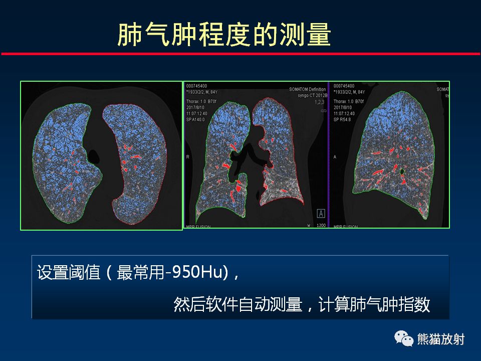 【PPT】放射科医生如何应对慢阻肺