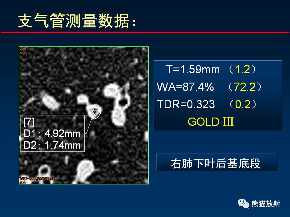 【PPT】放射科医生如何应对慢阻肺