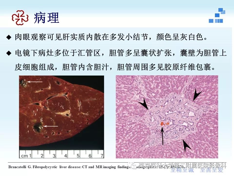 【PPT】胆管错构瘤