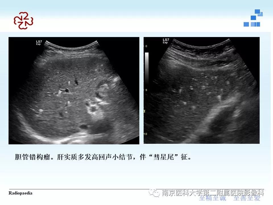 【PPT】胆管错构瘤