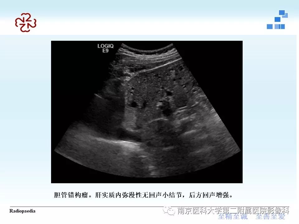 【PPT】胆管错构瘤