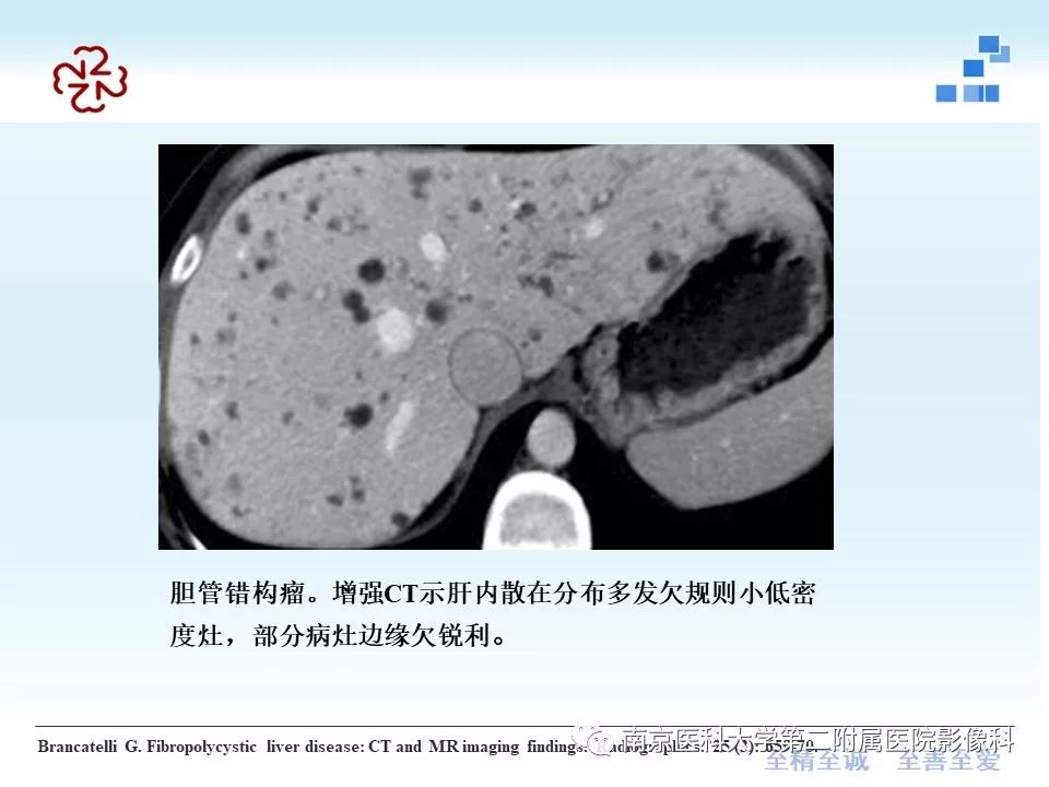 【PPT】胆管错构瘤