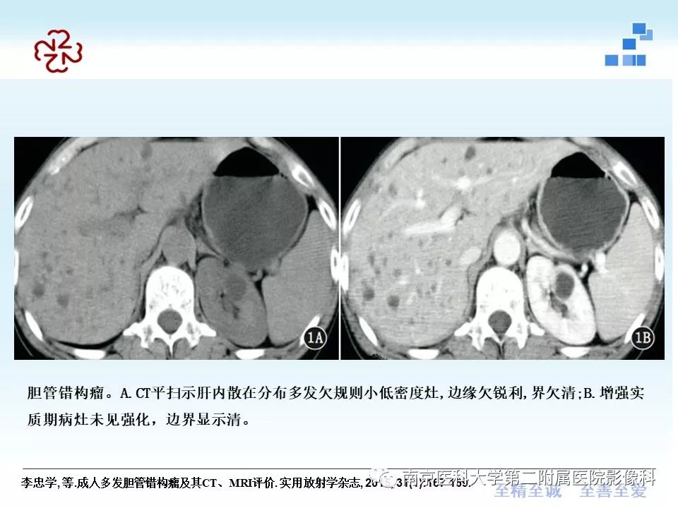 【PPT】胆管错构瘤
