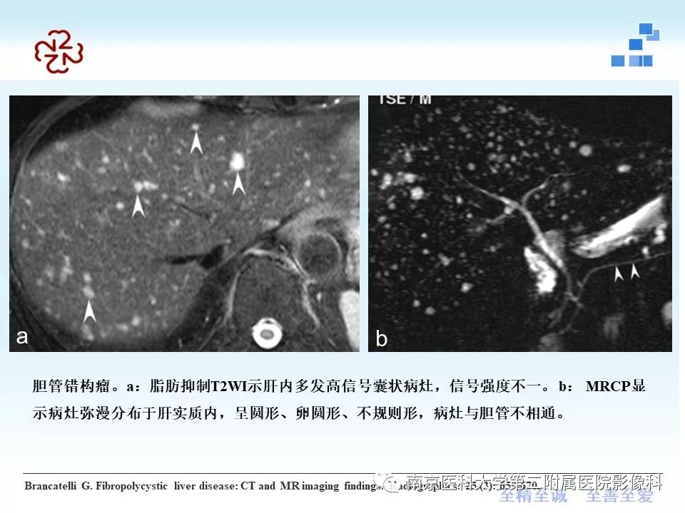 【PPT】胆管错构瘤