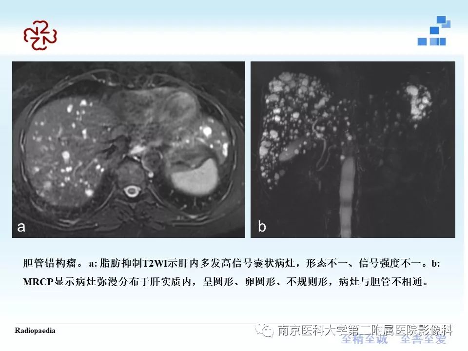 【PPT】胆管错构瘤