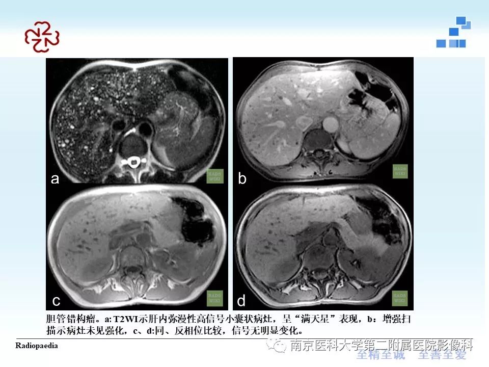 【PPT】胆管错构瘤