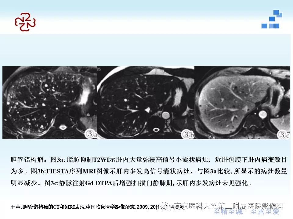 【PPT】胆管错构瘤
