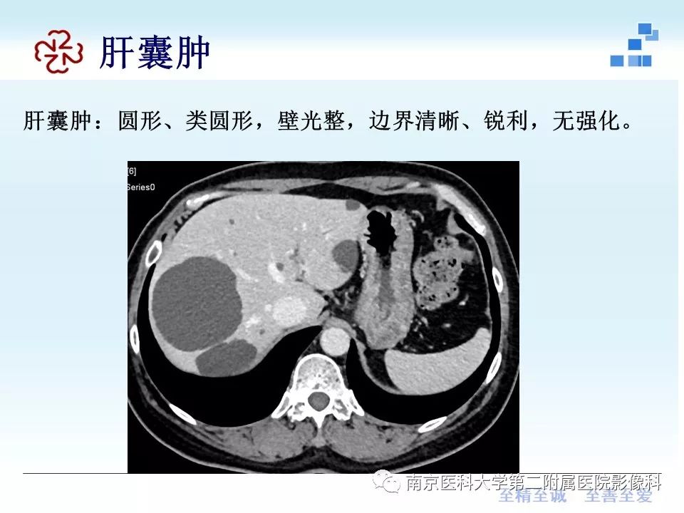 【PPT】胆管错构瘤