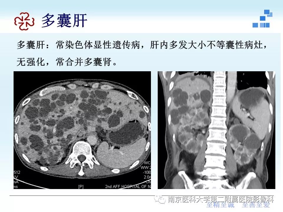 【PPT】胆管错构瘤