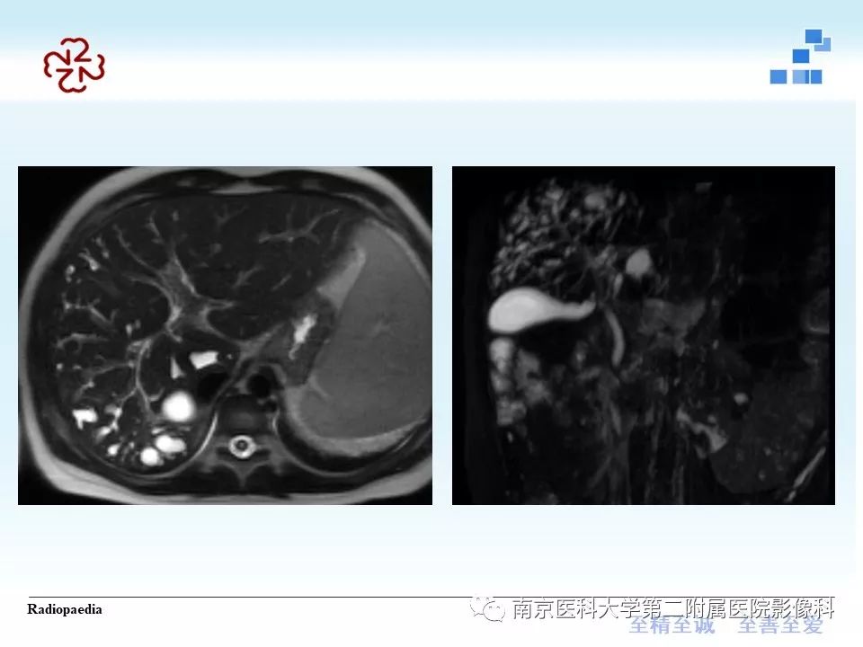 【PPT】胆管错构瘤