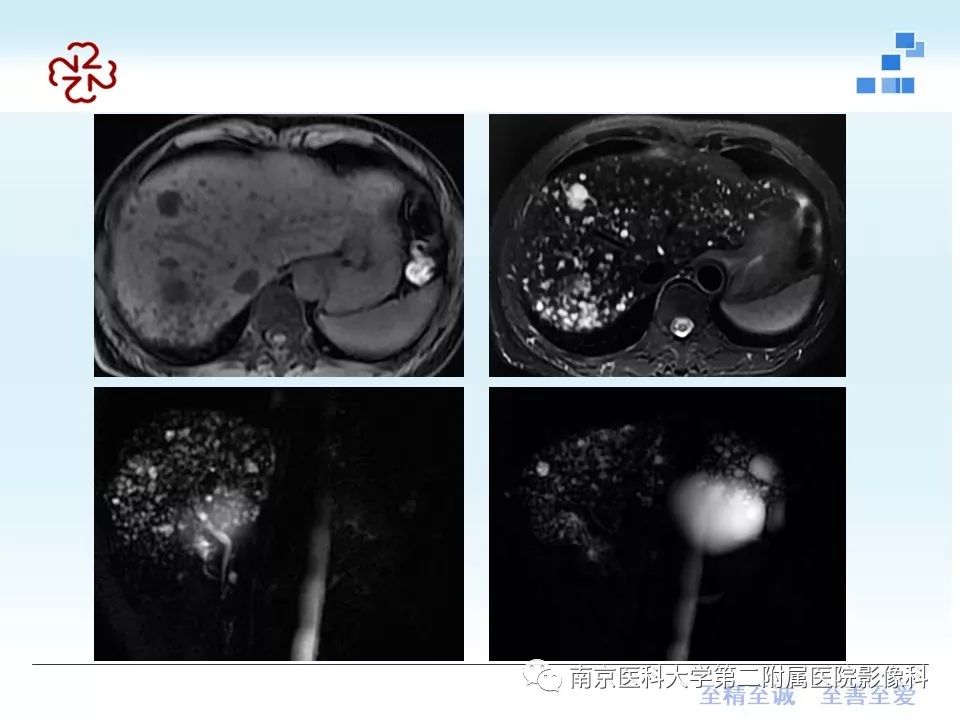 【PPT】胆管错构瘤