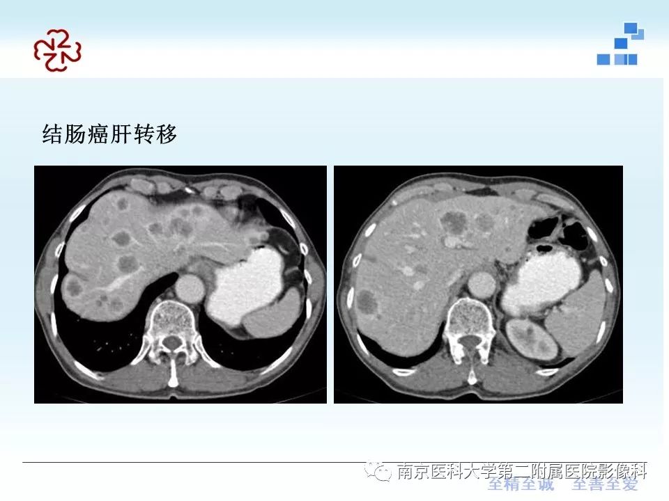 【PPT】胆管错构瘤