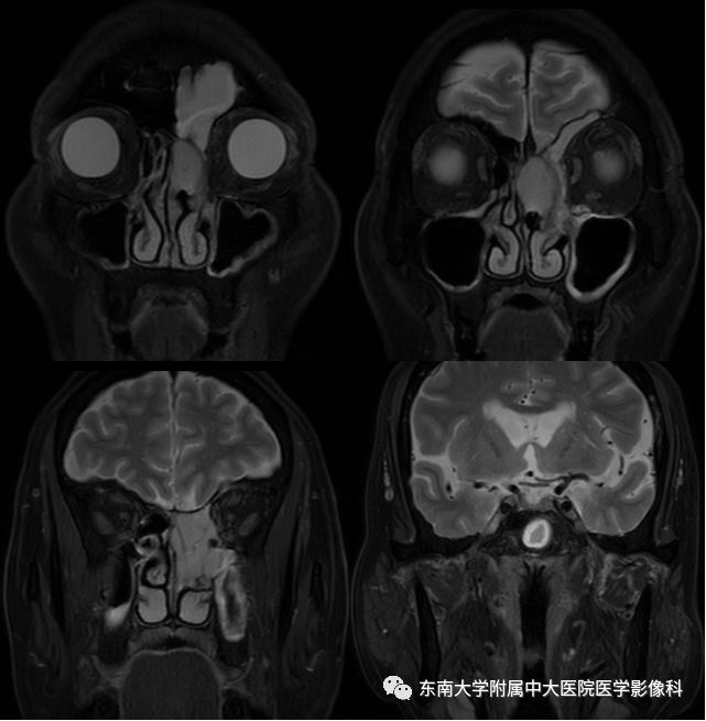 【病例】嗅神经母细胞瘤1例MR影像诊断