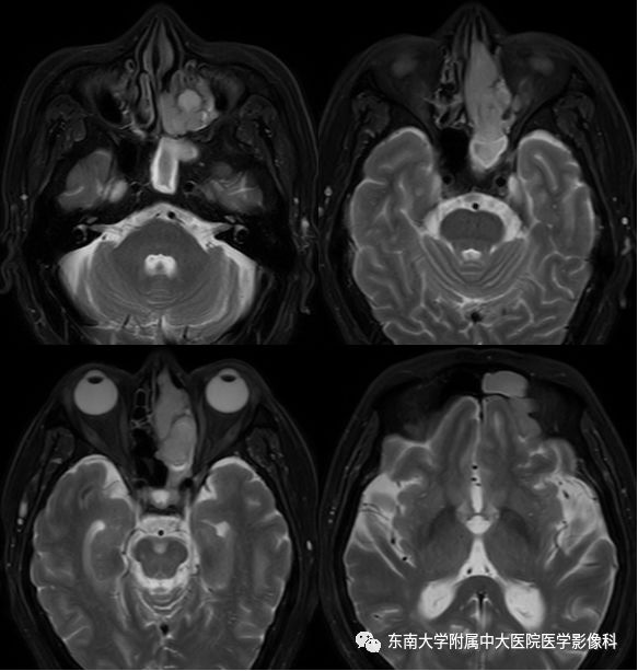【病例】嗅神经母细胞瘤1例MR影像诊断