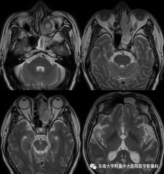 【病例】嗅神经母细胞瘤1例MR影像诊断