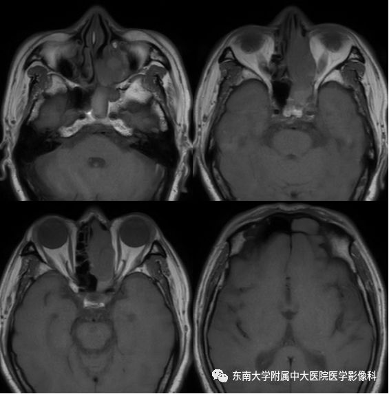 【病例】嗅神经母细胞瘤1例MR影像诊断