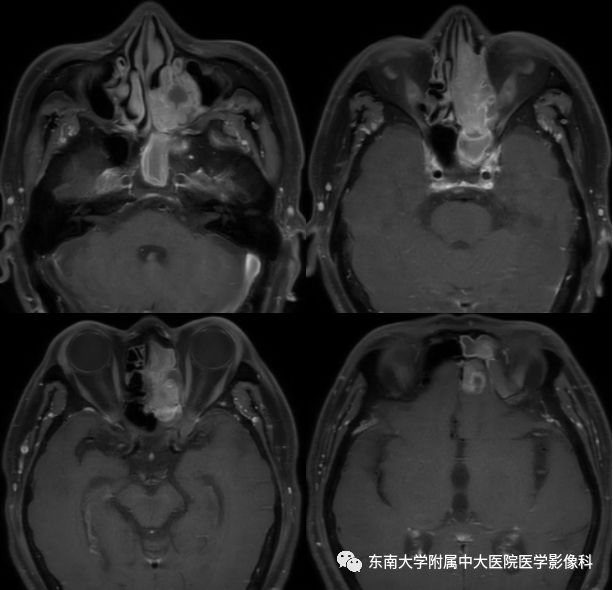 【病例】嗅神经母细胞瘤1例MR影像诊断
