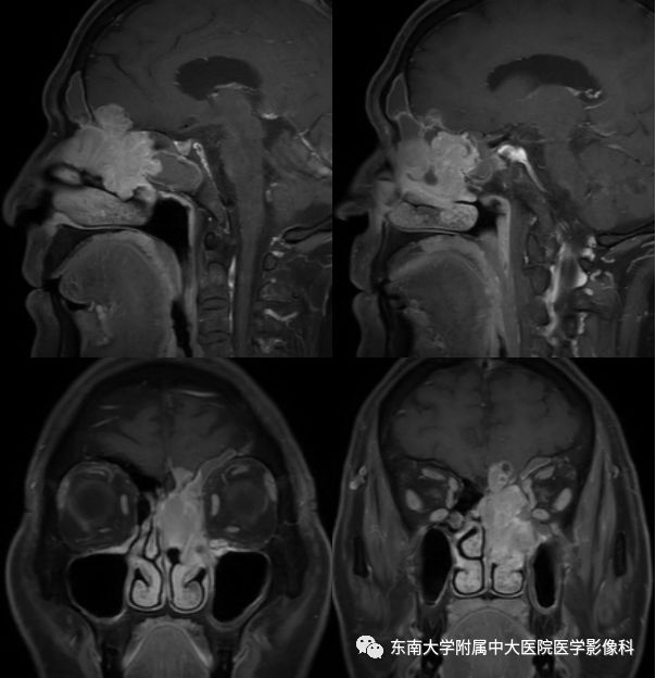 【病例】嗅神经母细胞瘤1例MR影像诊断
