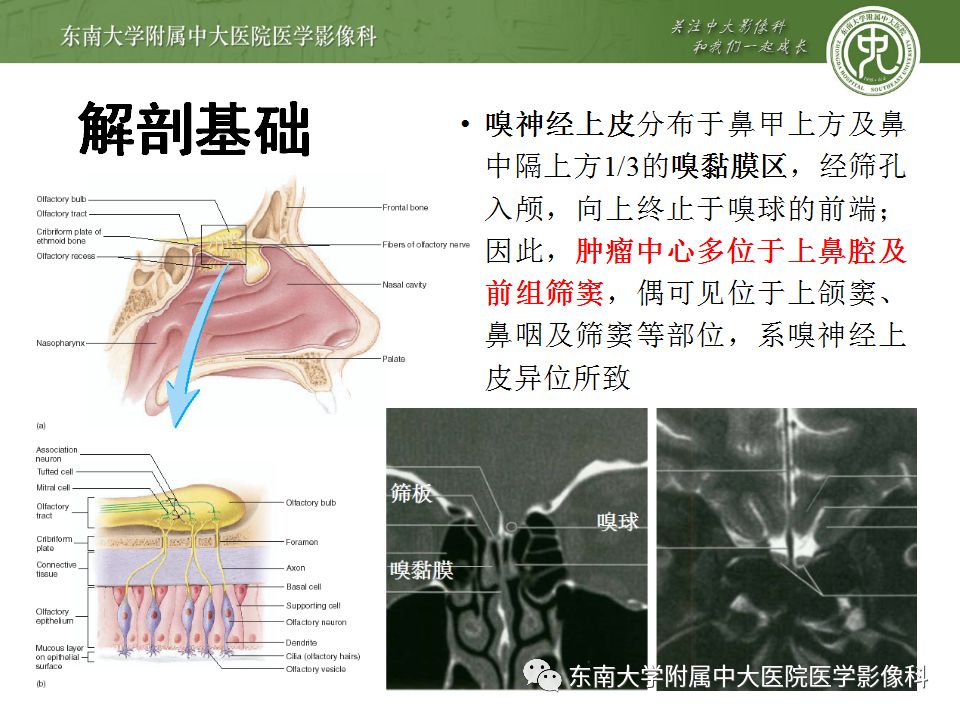 【病例】嗅神经母细胞瘤1例MR影像诊断